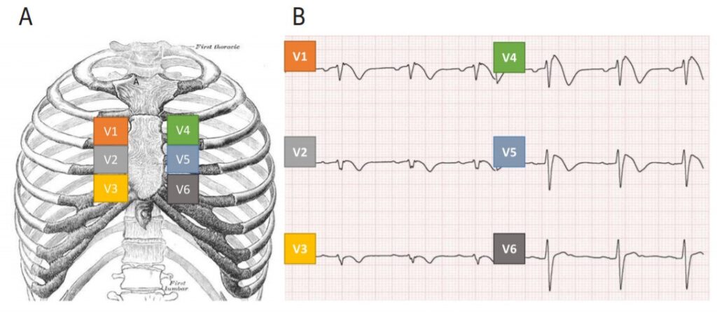 sd. Brugada (fonte: ABC Cardiol - Soc. Brasileira de Cardiologia)